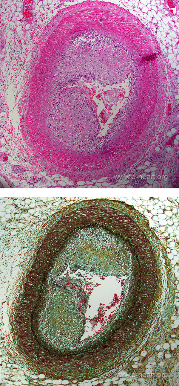 Vasculopathy